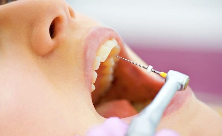 Interesting Facts About Endodontics Interesting Facts About Endodontics